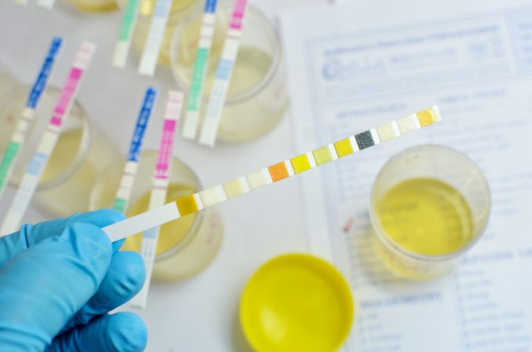 Vizeletvizsgálat laboratóriumi mintával illusztrálva